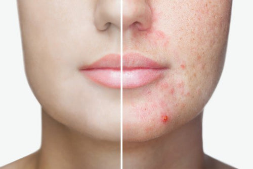 Top 5 Most Effective Products for Getting Rid of Pimples Once and For All