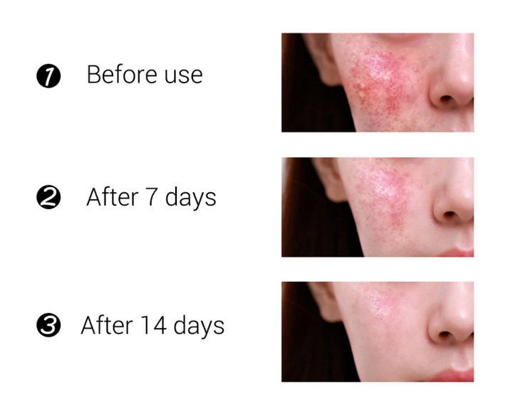 Acne Repair & Treatment Set